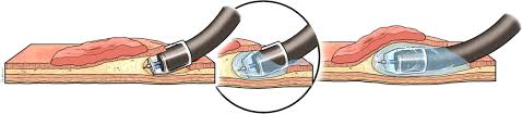 Endoscopic Submucosal Dissection